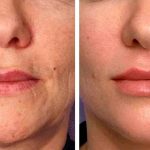 Fotona laser based modern technology can work wonders for you