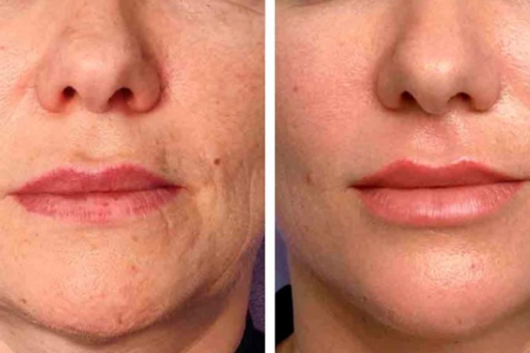 Fotona laser based modern technology can work wonders for you