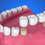 Some compelling reasons to help you consider the utilisation of crowns and bridges