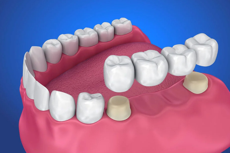Some compelling reasons to help you consider the utilisation of crowns and bridges